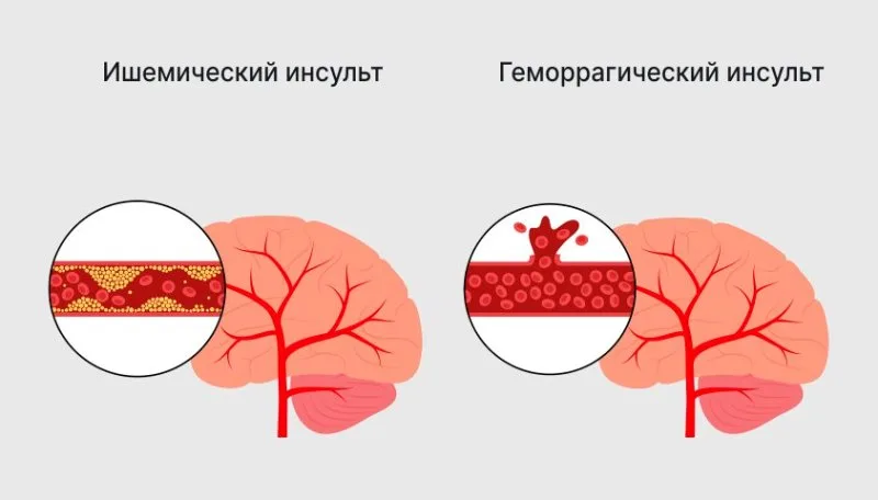 типы инсульта