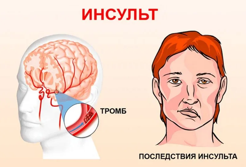 признаки инсульта