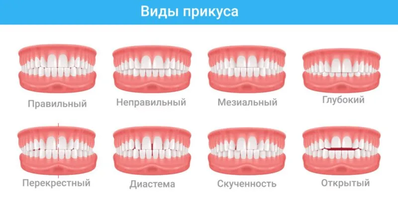 Виды прикуса