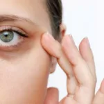 Что делать, чтобы убрать мешки под глазами?