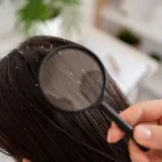 Як позбавитись від перхоті