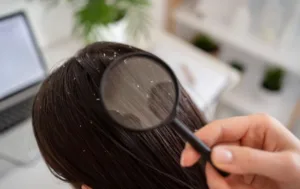 Як позбавитись від перхоті